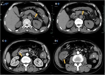 Intestinal obstruction due to idiopathic mesenteric phlebosclerosis colitis: A case report